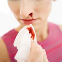 krwotok z nosa