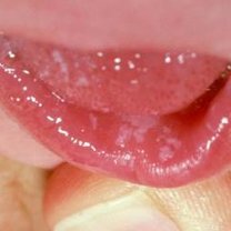 grzybica jamy ustnej u dzieci