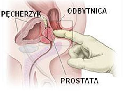 Jaki wpływ ma u mnie problem prostaty na erekcję?