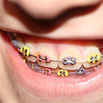 Aparat ortodontyczny na zęby