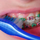 Mycie zębów z aparatem ortodontycznym