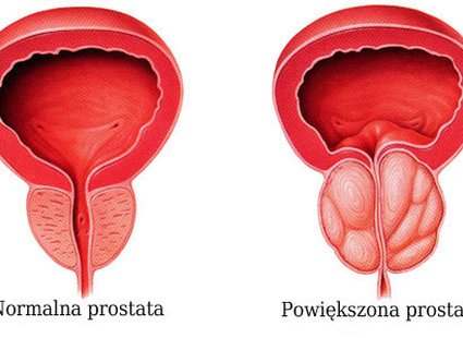mikstura na prostatę