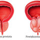 prostata - normalna i powiększona
